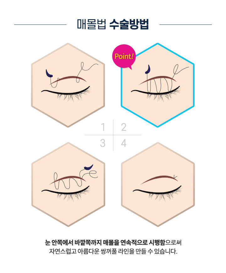 매몰법 수술방법