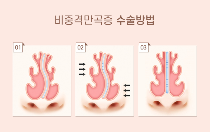 비염코성형