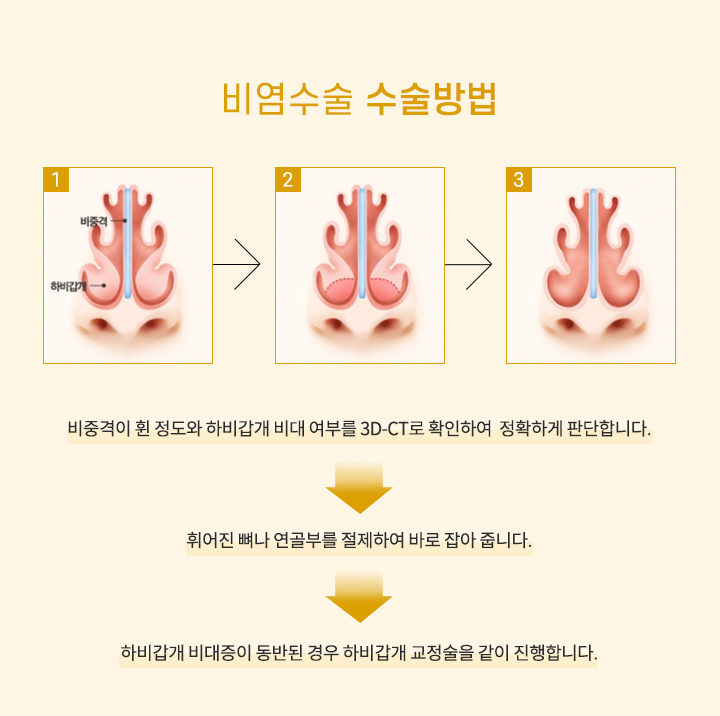 비염수술 수술방법