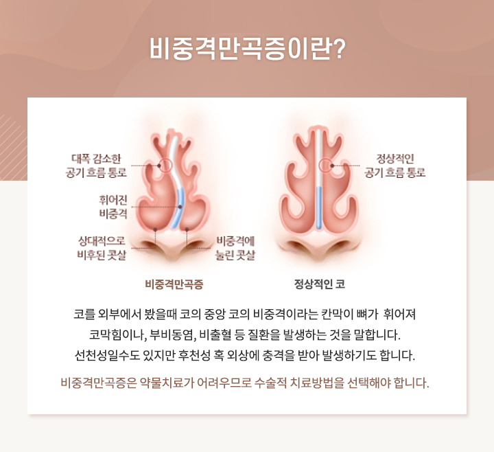 비중격만곡증이란