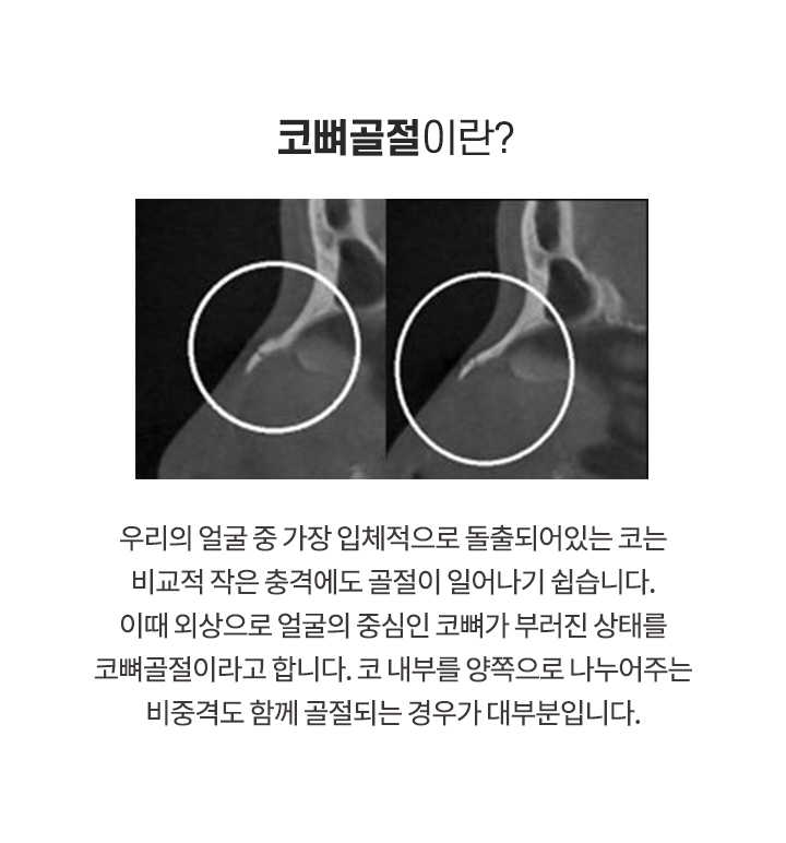 코뼈골절이란