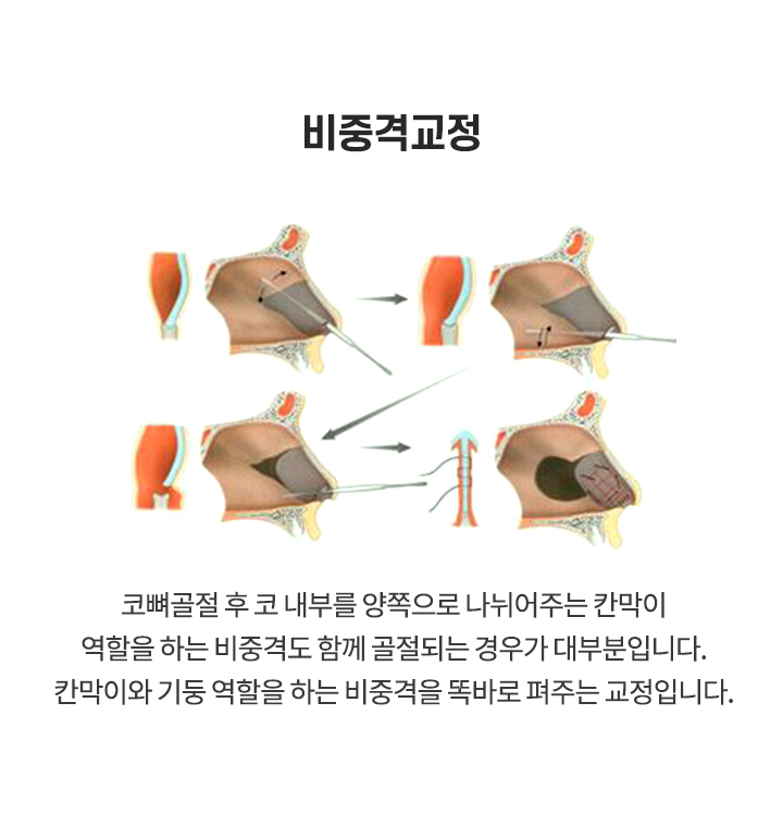 코뼈골절 비중격교정