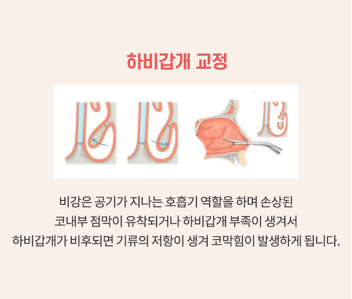 코뼈골절 하비갑개 교정