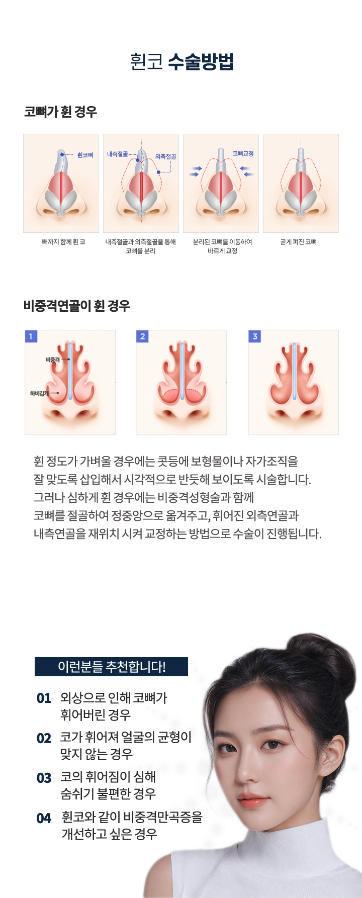 휜코수술방법