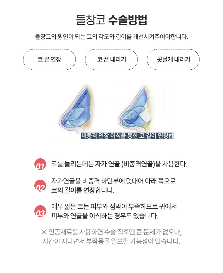 들창코 수술방법