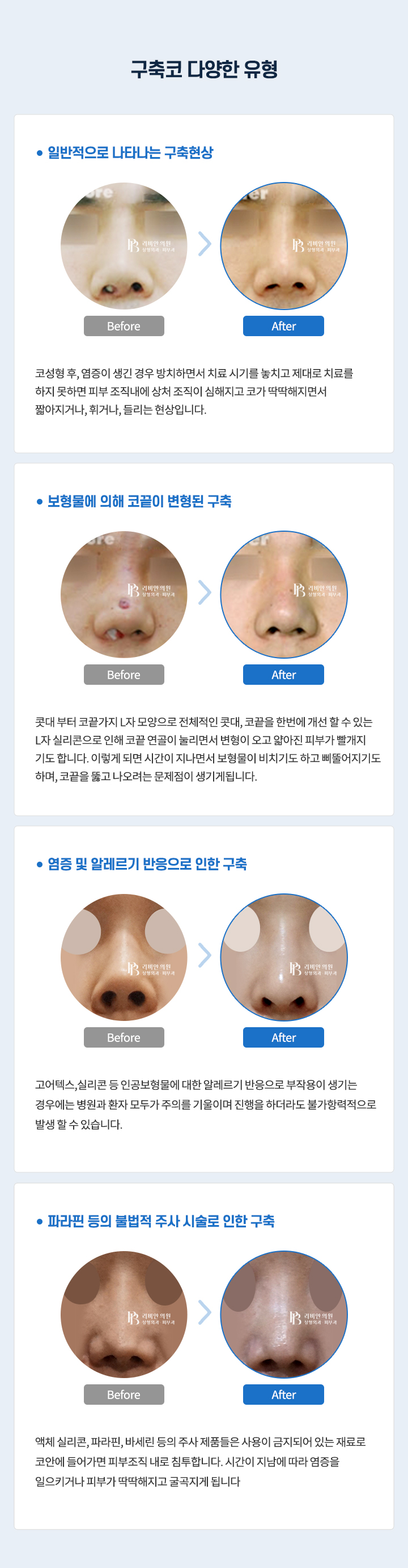 구축코 다양한 유형